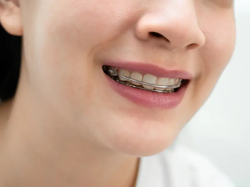 Baragazza - Allineatori trasparenti