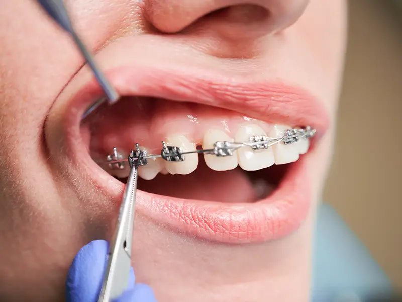 Baragazza - Ortodonzia fissa